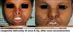 Before After Pictures,Nose job,Rhinoplasty,Delhi,Nose Reconstruction